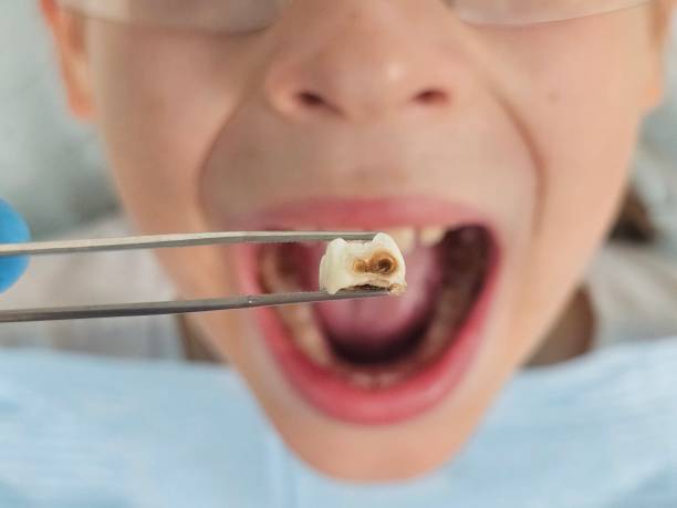 Best Emergency Tooth Extraction in Erie, CO